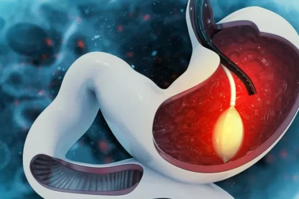 Tüp Mide Ameliyatı