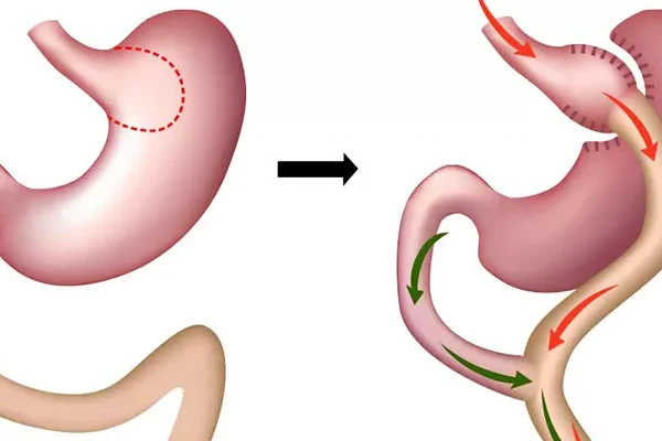 Gastrik ByPass Ameliyatı
