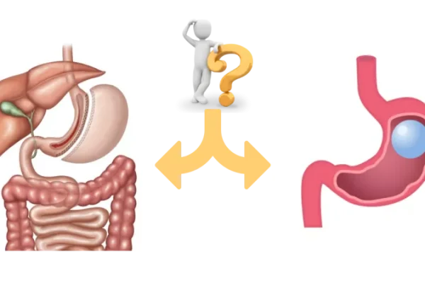 Kilonuzu Kontrol Altına Almanın Yolları: Tüp Mide Ameliyatı mı, Mide Balonu mu?